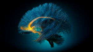 a human brain showing 3D white matter structure (blue-dark blue) and a targeted region (yellow-orange) for deep brain stimulation