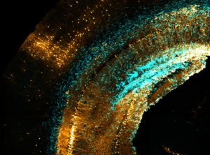 vast landscape of neurons (orange) in the mouse brain that synapse onto infiltrating glioblastoma cells (blue)